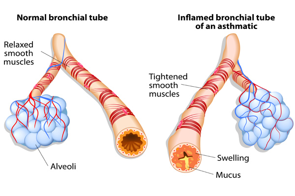 case study of asthma for physiotherapy